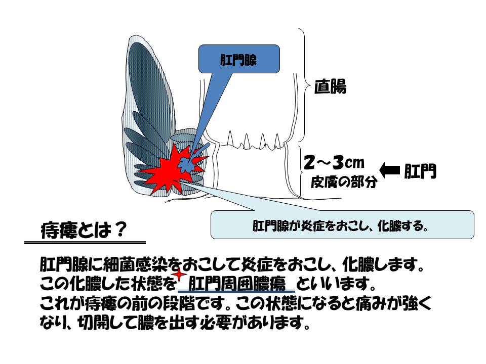 痔瘻ってどんな病気？Q＆A方式で。 渡邉医院